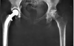 Hip replacement xray